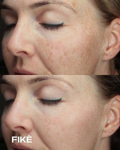 Vasculaire pigmentatie